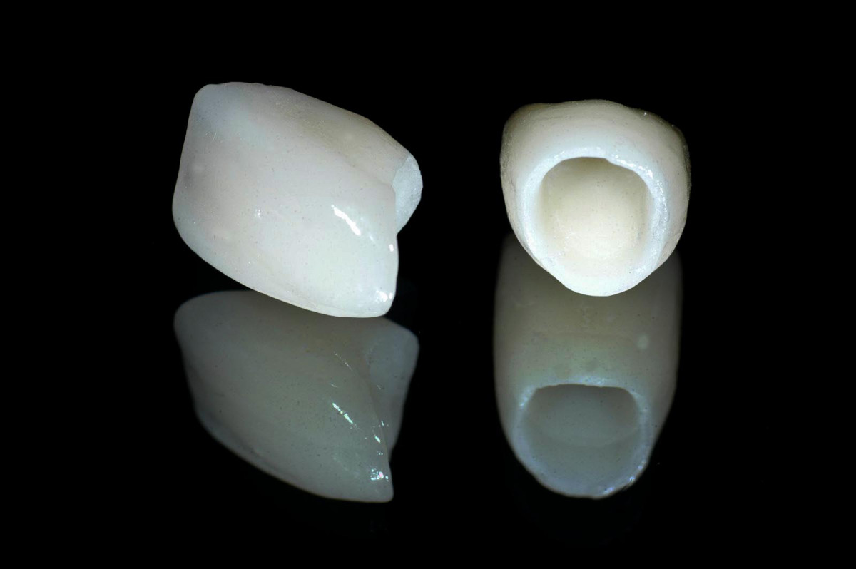 Фото зубов из циркония и металлокерамики в сравнении